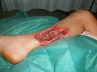 Flesh eating disease.jpg